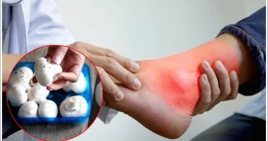 High uric acid and mushroom intake for gout patients