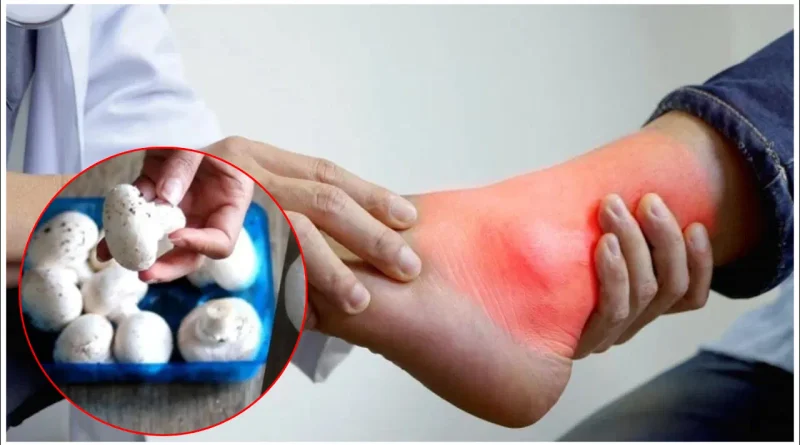High uric acid and mushroom intake for gout patients